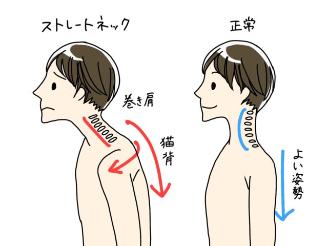 猫背の原因は背中ではない？